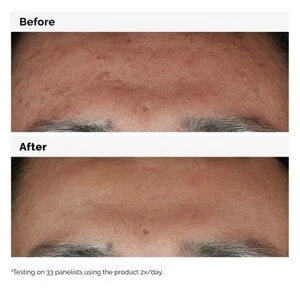 The Ordinary Niacinamide 10% + Zinc 1% (30 ml) — view 5